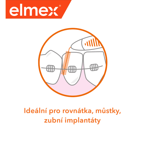 Ilustrace mezizubního kartáčku a zubní péče pro osoby s rovnátky, můstky a zubními implantáty.